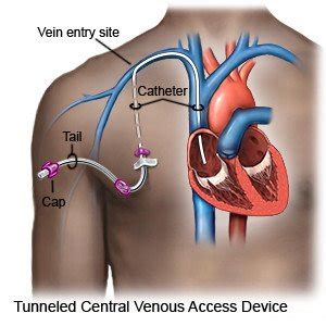 How to Care for your Implanted Venous Access Port - What You Need to Know