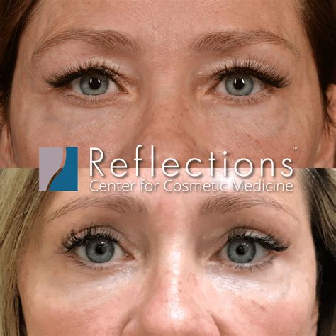 Upper Eyelid Surgery Before and After Before & After Photos New Jersey ...