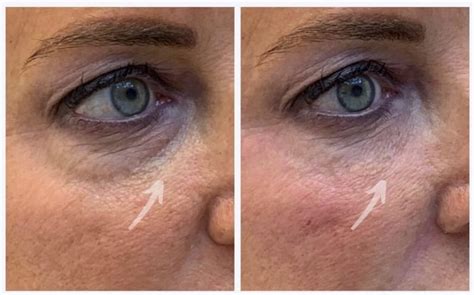 Tear Trough Filler in Edison, New Jersey | Tear Trough Filler Before After