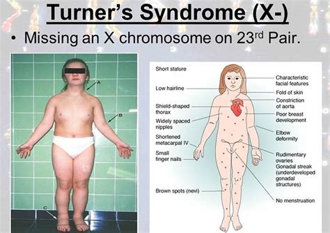 Turner Syndrome - Causes, Symptoms, Life Expectancy, Treatment