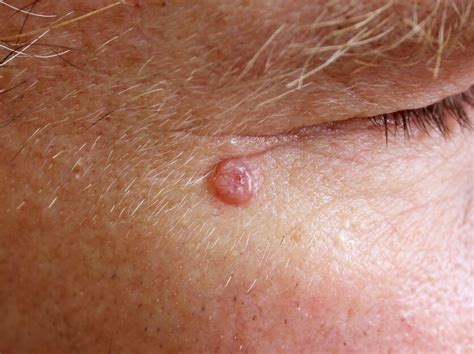 Basal Cell Carcinoma | Facial Skin Surgery | Worcestershire Ear, Nose ...