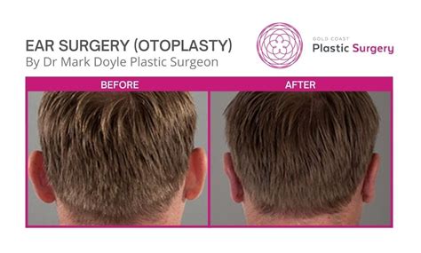 Otoplasty Before and After Photos Gold Coast | Gold Coast Plastic Surgery