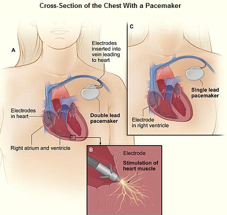The EKG in a patient with a pacemaker - wikidoc