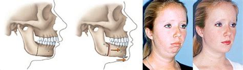 Corrective Jaw Surgery Sydney | Orthognathic Surgery