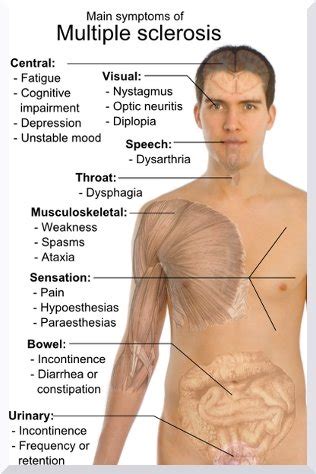 Signs of Multiple Sclerosis