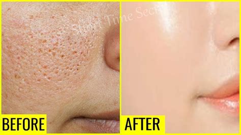 In Just 3 Days Reduce Large OPEN PORES Permanently | OPEN PORES ...