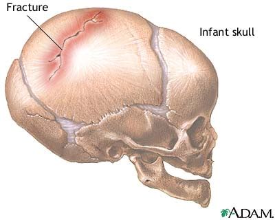 Infant skull fracture: MedlinePlus Medical Encyclopedia Image