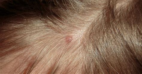 Here's How to Treat Pimples on Scalp: Home Remedies Causes, and Prevention