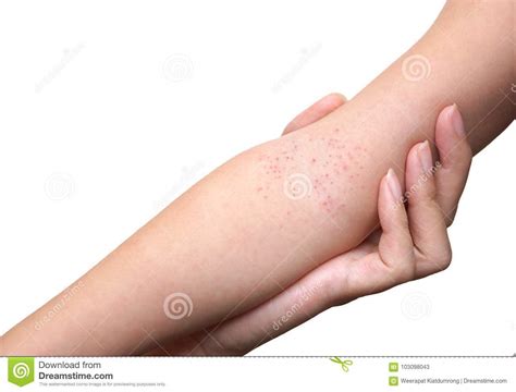 Red rash on baby skin stock image. Image of suffer, allergy - 103098043