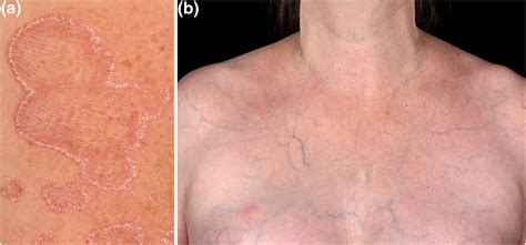 The role of cutaneous manifestations in the diagnosis of the Ehlers ...