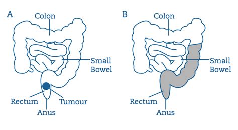 da Vinci® assisted Low Anterior Resection in Tijuana, Mexico | Angeles Hospital