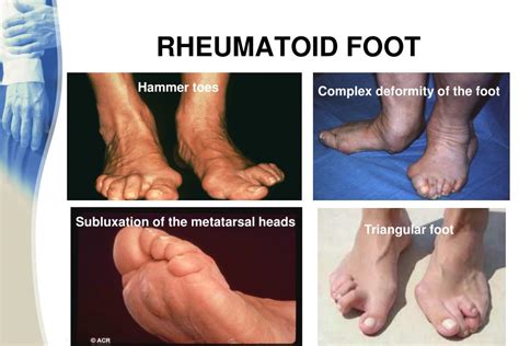 PPT - RHEUMATOID ARTHRITIS (RA) PowerPoint Presentation, free download - ID:6035494