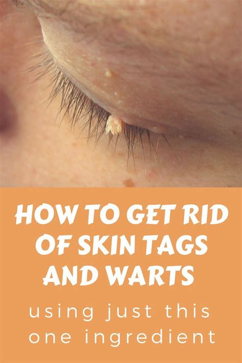 How to get rid of skin tags and warts using just this one ingredient ...