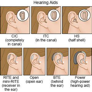 Hearing aid – structure and types. How to choose a hearing aid? [WE ...