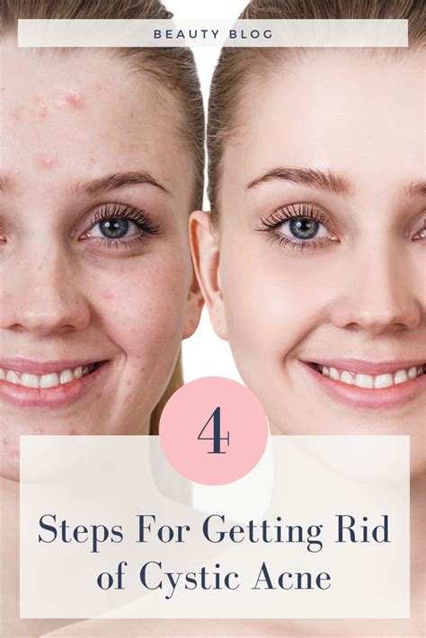 4 steps for getting rid of cystic acne - Biodroga and Dr. Grandel Professional Skincare for ...