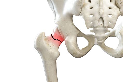 Diagnose a hip fracture | Treatment of hip fracture at Zehr Center