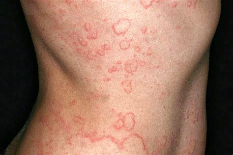 Chronic Spontaneous Urticaria: What to Know – isdnnews