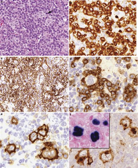 Angioimmunoblastic T-cell lymphoma with Hodgkin-Reed Sternberg-like ...