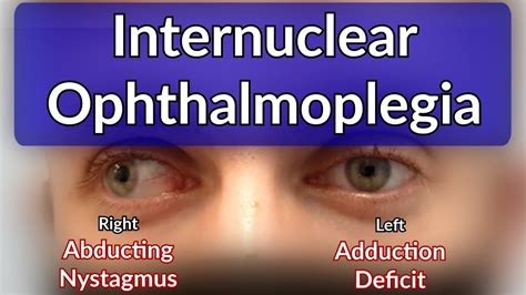 Internuclear Ophthalmoplegia - Left INO Case example explained - YouTube