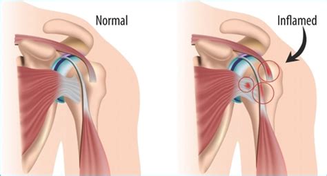 What Is Shoulder (Subacromial) Bursitis? Arthritis-health, 52% OFF