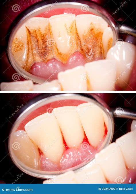 Before and after stock image. Image of periodontal, hygiene - 30240909