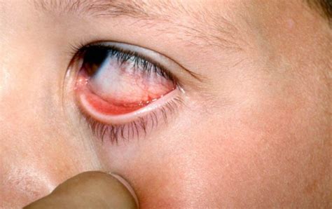 Parinaud Oculoglandular Syndrome: Causes and Treatment | OBN