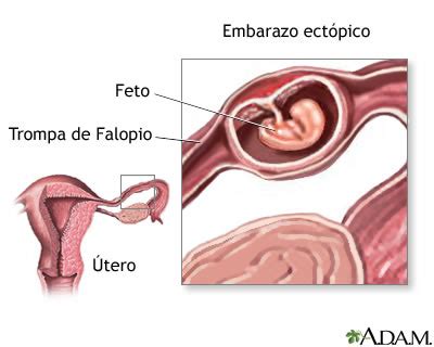 Embarazo ectópico: síntomas, causas y tratamiento