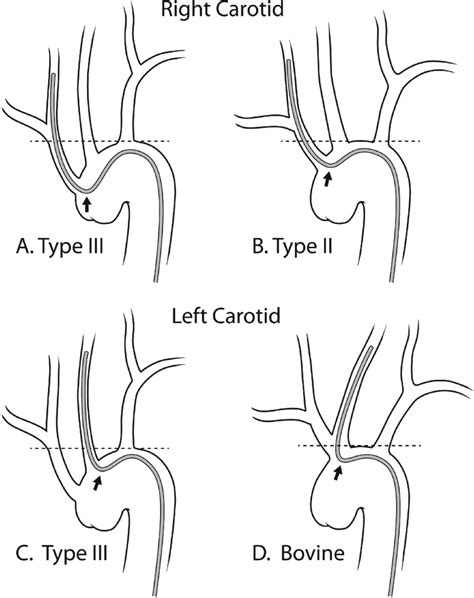 Schematic examples of unfavorable aortic arch anatomy. (A) Type III... | Download Scientific Diagram