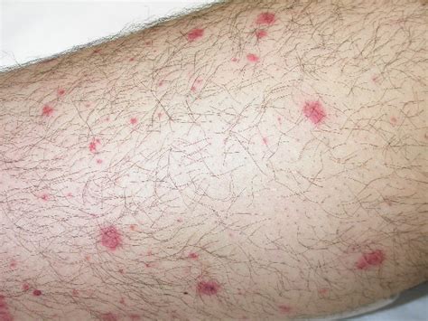 Red Spots On Skin Petechiae | Images and Photos finder