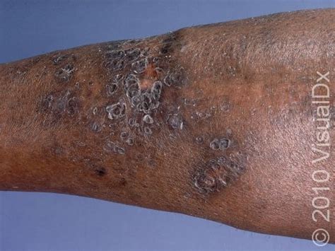 Diabetic Dermopathy Condition, Treatments and Pictures for Adults ...