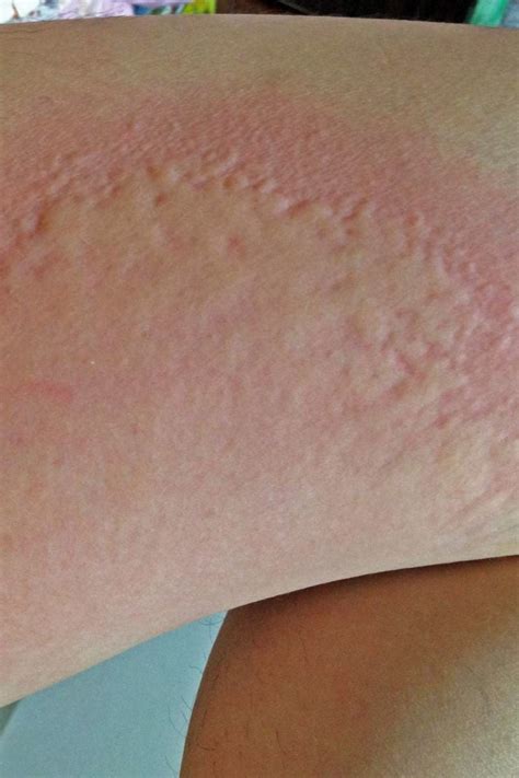 Hepatitis Skin Rash Pictures