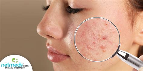 Hormonal Acne: Causes, Symptoms, and Treatment