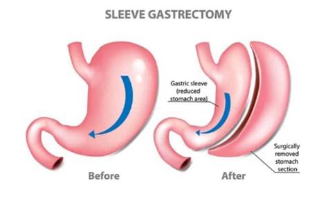Gastric Sleeve Surgery In Huntsville, AL | Starting At $9,500!