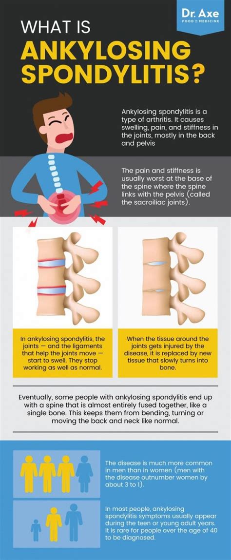 What is ankylosing spondylitis? - Dr. Axe #Backpain | Ankylosing ...