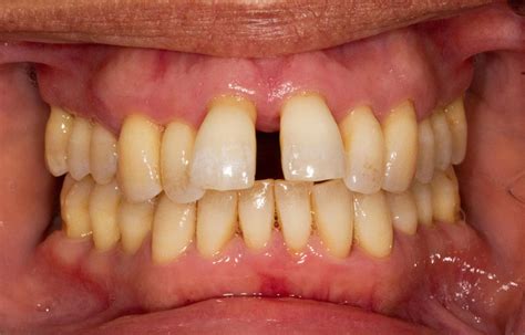 Gum disease | Gallions Reach Dental Clinic