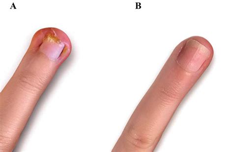 Worst Ingrown Fingernail