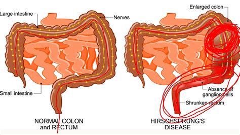 Hirschsprung's Disease - YouTube