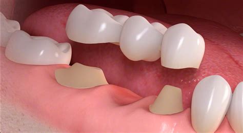 Dental Bridges, a Complete Overview