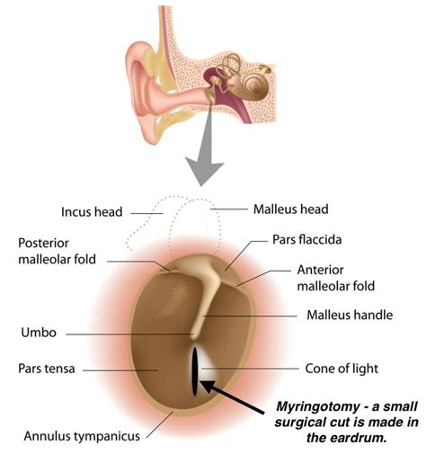 Office Tympanostomy Tube Placement - Fort Worth ENT & Sinus