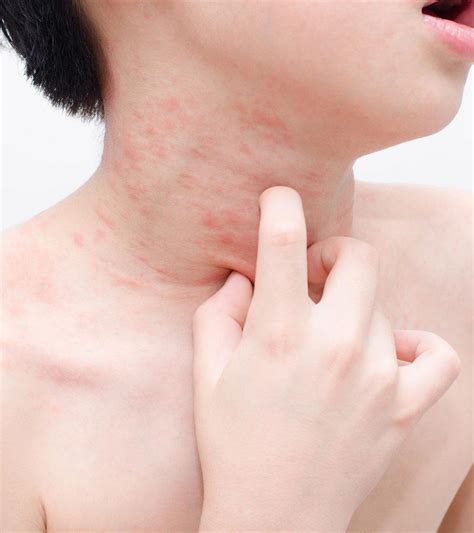 Skin Rashes In Children