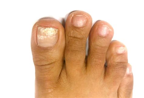 White Superficial Onychomycosis: Types, Symptoms, Causes & Treatment