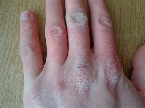 Atopic dermatitis hand - BioSol