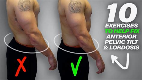 10 Exercises to Help Fix Anterior Pelvic Tilt & Lordosis - YouTube