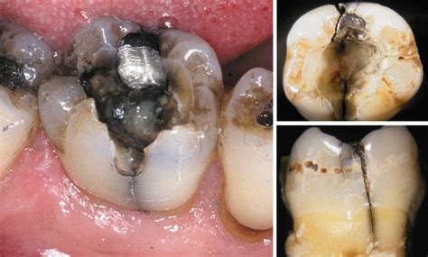 Acute dental pain II: pulpal and periapical pain | Den norske ...