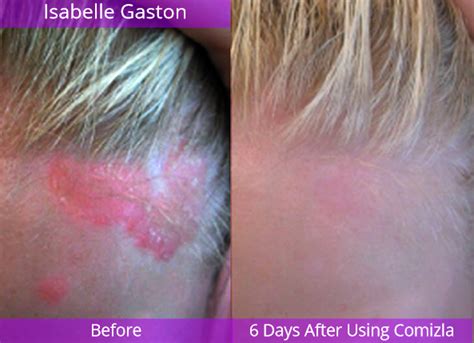 Results – Comizla Psoriasis Cream