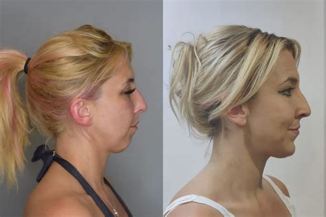 Chin Lipo Before and After: The Anatomy - Best Chin Lipo Results