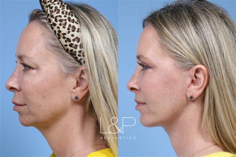 Facelift Before and After Pictures, at L&P Aesthetics in Palo Alto, CA. by Drs. Lieberman and Parikh