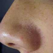 Large Nose Pores - Causes of Large Nose Pores, Treatments For Large Nose Pores