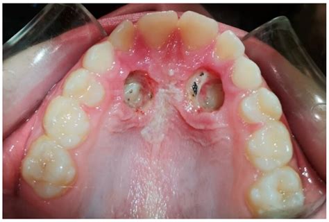 Applied Sciences | Free Full-Text | Disinclusion of Palatally Impacted Canines with Surgical and ...