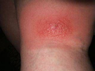 Brown Recluse Spider Bite Rash